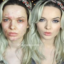 Tuyệt chiêu trang điểm che mụn thần thánh