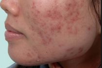 Gột sạch mụn cùng vết thâm nhờ công thức đơn giản sau